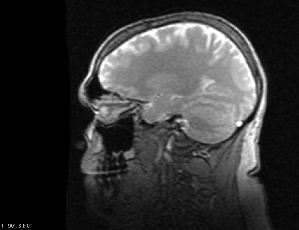 be3n brain (MRI scan)